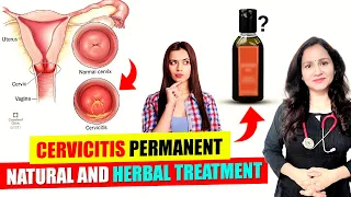 Everything About Cervicitis | Cervicitis Treatment And Causes | Ayurvedic Treatment For Cervicitis