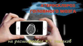 ДИСЦИРКУЛЯТОРНАЯ ЭНЦЕФАЛОПАТИЯ головного мозга и АТЕРОСКЛЕРОЗ АРТЕРИЙ на расшифровке КТ мозга