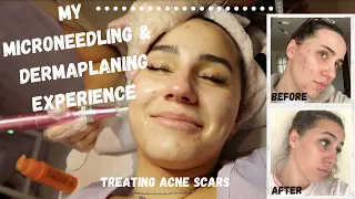 MY MICRONEEDLING EXPERIENCE FOR ACNE SCARS | BEFORE AND AFTER | Mil & Char