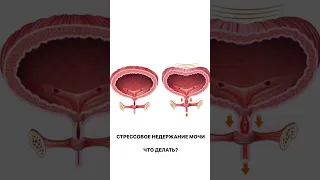 Стрессовое недержание мочи: эффективно решение проблемы