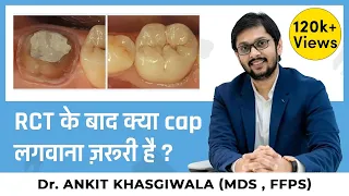 RCT के बाद कैप क्यों ज़रूरी है? ? Do we really need a cap on root canal treated tooth ? Dr. Ankit