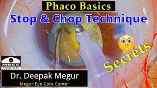 Phaco Basics - Stop & Chop technique  Re visited  - Dr Deepak Megur