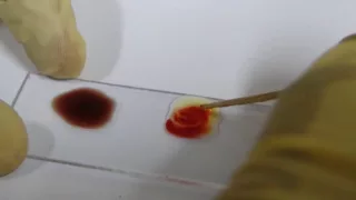 Blood Grouping Experiment - Amrita University