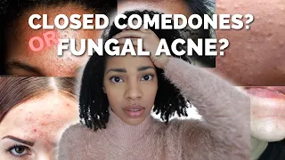 Fungal Acne(Malassezia) or Closed comedones? Here's the difference.