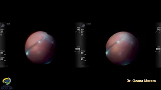 Pars-plana Vitrectomy for Late Fungal Endophthalmitis in DSAEK Operated Eye (post-previous PK)