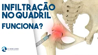 BURSITE DO QUADRIL: Infiltração funciona?