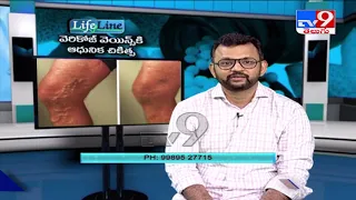 Varicose Veins Symptoms, Causes & Treatment  Explained by Dr. Rajah V Koppala  | Avis Hospitals