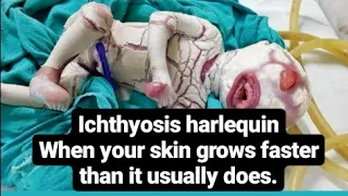 Harlequin-type ichthyosis when your skin grows at a faster rate than it usually does.