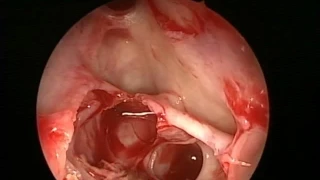 CSF leak UNEDITED ( Case 7 ) - Dr. Satish Jain - www.skullbase360.in