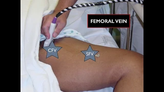 DVT Ultrasound of the Lower Extremities STEP by STEP