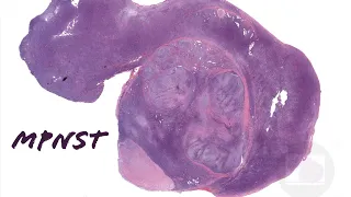 MPNST (malignant peripheral nerve sheath tumor) & plexiform neurofibroma in NF1/neurofibromatosis