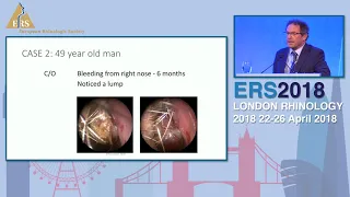 ERS London 2018, Benign Tumours In The Nose, Panel Session