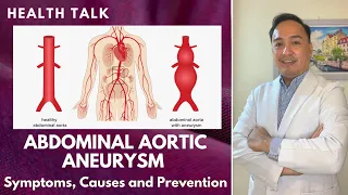 What is Abdominal Aortic Aneurysm? Symptoms, Causes and Prevention