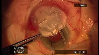 Ahmed Glaucoma Drainage Tube