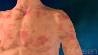 Hives Animation