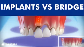 Dental Implants VS Tooth bridge - Comparison ©