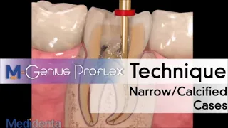 Genius Proflex Narrow Calcified Canals