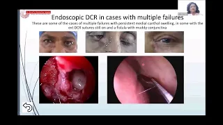 Endoscopic orbital decompression, optic nerve decompression, Endoscopic Dacryocystorhinostomy (DCR)