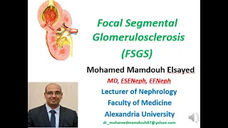 Focal segmental glomerulosclerosis (FSGS)