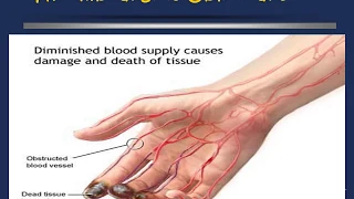 Burgers disease and raynaud's disease