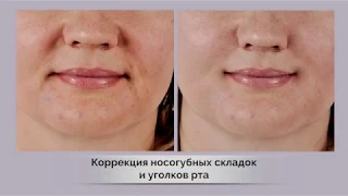 Контурная пластика носогубных складок.  Омоложение лица филлер juvederm | косметология Самара