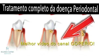 (Ep 87) Tratamento de doença periodontal