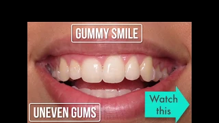Gummy smile or uneven gums? Our Waterlase laser will fix it comfortably and without surgery. Watch