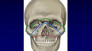 Facial Fractures 1