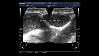 Ultrasound Video showing Dilated Gut loops with intestinal obstruction in a child of about 3 years.