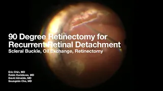 90 Degree Retinectomy for Recurrent Retinal Detachment