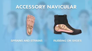 What is Accessory Navicular? - Ask Dr. Silverman