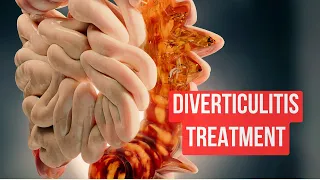 How To Treat Diverticulitis in 2024