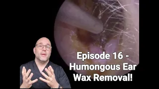 Episode 16 - Humongous Ear Wax Removal!