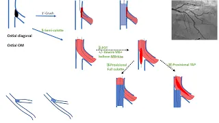 Ostial side branch stenting (esp. ostial diagonal): algorithms and cases -Elias Hanna