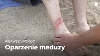 Naucz się gestów pierwszej pomocy - Żądło meduzy