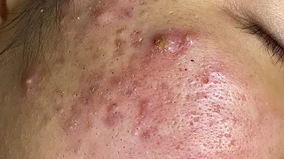 BLACKHEADS REMOVAL in a Teenager with Acne | Loan Nguyen Spa | April 7, 2021 (Oddly Satisfy)