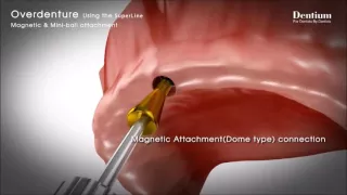 Superline Implant Overdenture system featuring Magnet and Mini Ball attachment