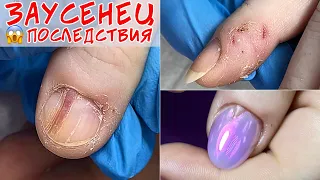 Infected cuticle / Panaritium consequences 😓