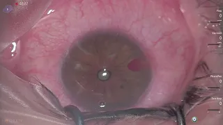 Corneal foreign body protruding in anterior chamber , ab interno removal Lukan Mishev Live stream