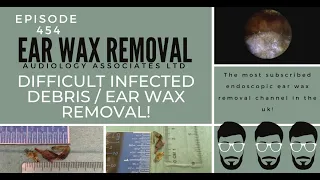 DIFFICULT INFECTED DEBRIS/EAR WAX REMOVAL - EP454
