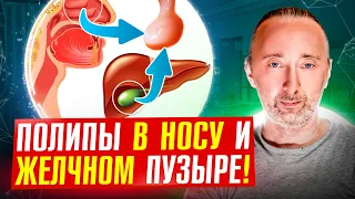 ПОЛИПЫ в носу, желчном пузыре можно убрать БЕЗ операций, ВОТ ТАК!