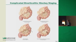 Diverticulitis: To Operate or Not?