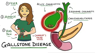 Gallstone Disease - Acute Cholecystitis vs Cholelithiasis vs Choledocholithiasis vs Cholangitis