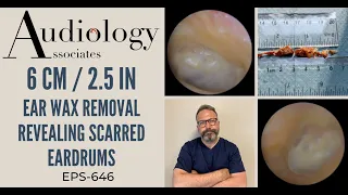 6CM/2.5IN EAR WAX REMOVAL - EP646