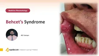 Behcet´s Syndrome | Rheumatology Medicine Video Lectures | Medical Student | V-Learning