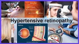 hypertensive retinopathy