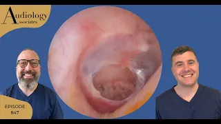 PERFORATED EARDRUM & TOUGH, DRY, DEEP EAR WAX REMOVAL - EP847