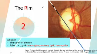 5 rules to evaluate the optic disc for glaucoma