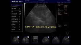 Braxton Hicks Contractions