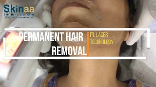 How IPL Laser Technology Removes Hairs Permanently | Skinaa Clinic, Jaipur